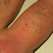 First instar bed bug nymph on finger
